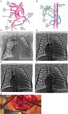 A Phenotype and Genotype Case Report of a Neonate With Congenital Bilateral Coronary Artery Fistulas and Multiple Collateral Arteries